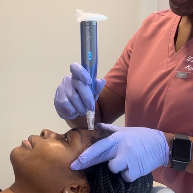 SkinPen Microneedling w/HA at Agoddess Spa & Wellness in DeSoto, TX